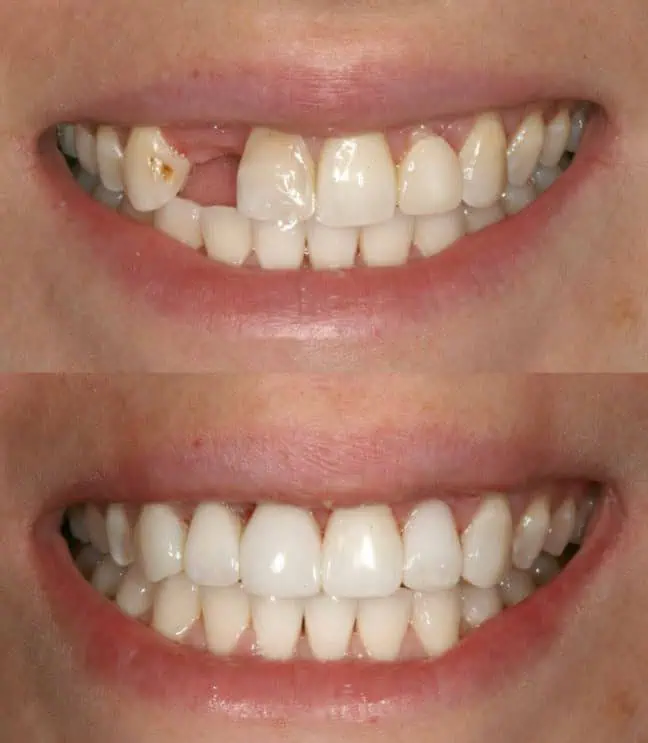 Before and after example of restorative and cosmetic dental care